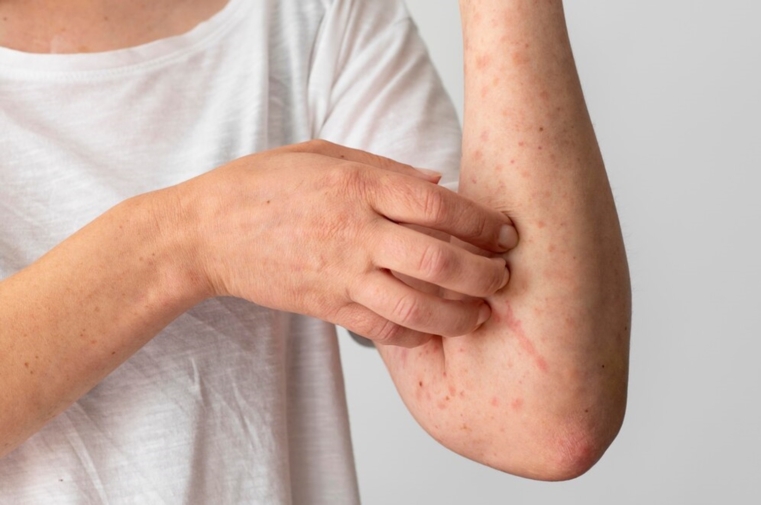 Remedios naturales dermatitis seborreica - Capilclinic ✔️