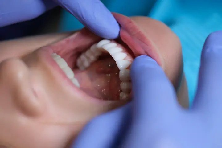 Qué son las carillas dentales: profesional revisando la boca de un paciente